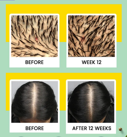 Alps Rosemary Water Spray for Hair Growth | Easy to Use Spray Bottle with Lock/ Unlock Button | Spray, Massage and Leave-in | Non-Greasy Formula and Needs NO Shampoo after Usage | Urbanestore